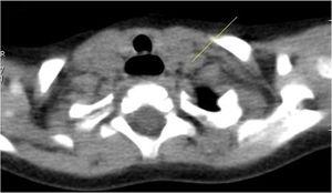 False positive non-malignant nodules by the Computed Tomography. 52 years woman with papillary thyroid carcinoma diagnosed by tumor histological data. The Computed Tomography image of the right thyroid lobe. Arrow indicates low-density mass.
