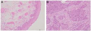 Pathological results from hypopharyngeal carcinoma patients (H&E, the scale bar is set at 400 μm). A, Pericarcinoma tissue; B, Carcinoma tissue.
