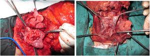 (a‒b) Tumors resected via combined lateral and infrahyoid pharyngotomy.