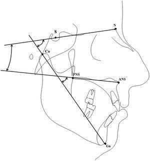 Tracing with the cephalometric variables used for the present study. S, Sella point; N, Nasion point; ANS, Anterior Nasal Spine; PNS, Posterior Nasal Spine; Co, Condylion point; Gn, Gnathion point.