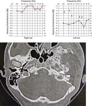 Pure tone audiometry showing moderate hearing loss. Tomography of temporal bones, axial view, showing resection of a dysplastic lesion of the temporal bone on the left, with a small remnant in the petrous portion and exclusion of the external auditory meatus.