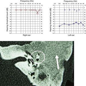 Pure tone audiometry with severe conductive hearing loss. Tomography of temporal bones in the axial view, left side. The circle shows a reduction in the tympanic cleft and the arrow shows ground-glass lesion affecting the squamous and mastoid portion.