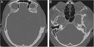 Tomography of temporal bones, axial views. (A) Partial resection of the squamous and parietal portions on the left. (B) Evolution with cholesteatoma in the mastoid and ipsilateral tympanic portions.