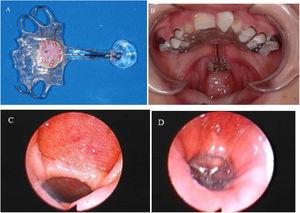 (A) View of the pharyngeal bulb prosthesis; (B) Intraoral view of the pharyngeal bulb prosthesis in place; (C) Nasoendoscopic view of the velopharyngeal gap without pharyngeal bulb prosthesis; (D) Nasoendoscopic view of the velopharyngeal gap with pharyngeal bulb prosthesis.
