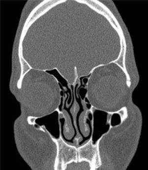 Is there a relationship between middle concha bullosa and ethmoid roof ...