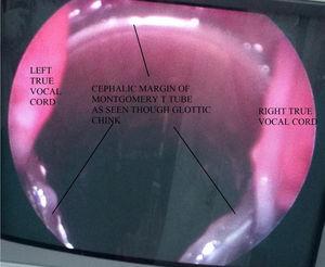 Our 12 year experience with Montgomery T-tube in the management of ...