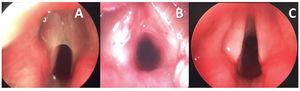 Case 1 — type II laryngeal web. (A) Intraoperative view before web incision; (B) subglottic stenosis revealed after web incision; (C) post-operative endoscopic view.