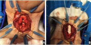 Grafting. LTR anterior and posterior graft being fixed to the expanded cricoid cartilage (Case 7) (A) posterior graft (B) anterior graft.