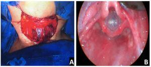 Stenting. (A) Intraoperative view of an inserted stent (Case 4); (B), endoscopic view of the LT-Mold (Case 3).