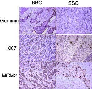 Representative sections of geminin, ki67 and MCM2 immunoexpression in head and neck cutaneous squamous cell carcinoma and basal cell carcinoma (scale bars represent 0.1mm, inset in BCC geminin expression shows ×400 magnification).