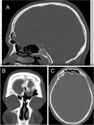 Triplanar CT scan (A, sagittal; B, coronal; C, axial planes) of a patient with traumatic CSF leak. Multiple skull base defects (frontal sinus posterior wall and ethmoid roof) are associated with anterior sinus wall fracture.