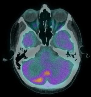 FDG-PET/CT showing FDG hypermetabolism in the right hemisphere and vermis of the cerebellum suggestive of secondary involvement.