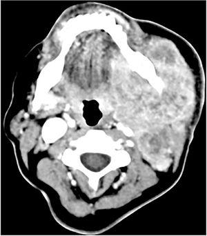 CT scan: Locally advanced left submandibular gland tumor.