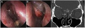 (A and B) Postoperative endoscopic view of bilateral grade 2 ethmoid polyps (arrows) in the same patient (Fig. 3). (C) Postoperative plain CT coronal cut in the same patient showing opacification of both ethmoid sinuses (arrows) due to bilateral polyposis.