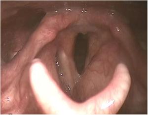 Videolaryngoscopy evaluation: infiltration of the glottic and supraglottic regions with signs of chronic laryngitis.