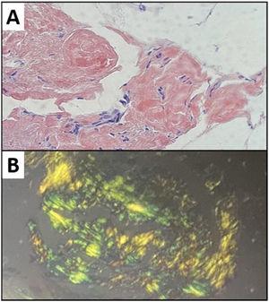 Laryngeal biopsy. (A) H&E. 40x: extensive amyloid material deposition in the chorion; (B) Congo red.