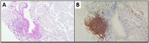 Laryngeal biopsy. (A) H&E. 10x: lymphoplasmacytic infiltrate associated with a respiratory mucosal pattern, with formation of lymphoid aggregate and peripheral plasmacytosis; (B) CD20: B-cell lymphoid aggregate.