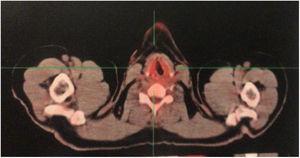 PET-CT, axial section of the cervical region. Discrete asymmetric radioconcentration.