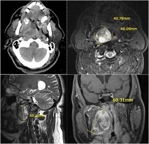 (a) Axial contrast-enhanced CT imaging. (b) Axial T2-weighted MRI. (c) Sagittal T2-weighted MRI. (d) Coronal plane T1-weighted fat suppressed and contrast-enhenced MRI.