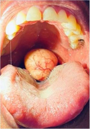 Intraoral appearance of the tumor.