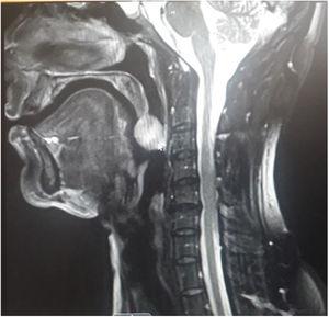 MRI showing ovoid enhancing mass lesion with well-defined margins hanging from tip of the uvula.