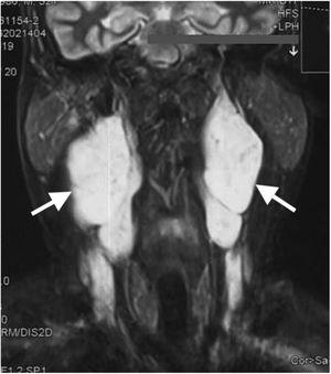 Coronal T2-weighted MRI image shows bilateral hyperintense masses (white arrows) at parapharyngeal space with heterogeneous contrast enhancement.