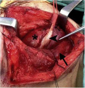 The tumor (*) located deep to sternomastoid muscle (arrow), attached to hypoglossal nerve (arrowhead).