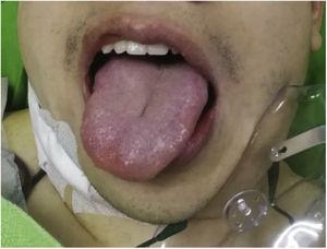 The patient developed right hypoglossal palsy immediate post-operation.