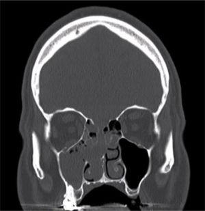 Noncontrast CT. Coronal cut demonstrating complete opacification of the right maxillary sinus with partial opacification of the ethmoid air cells as well as thinning of the skull base.
