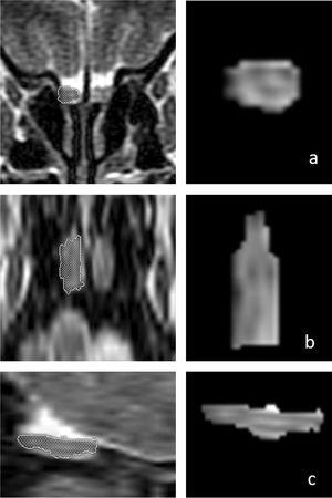 Three-dimensional measurements of the right olfactory bulb (OB) volume in a 66-year-old male patient on T2-weighted coronal (a, first row), axial (b, middle row), and sagittal (c, bottom row) magnetic resonance images. The patient’s right OB volume was 76 mm3 after olfactory rehabilitation.