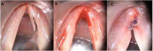 Surgical technique. (A) Initial aspect. (B) De-epithelization of the anterior third of the membranous vocal folds. (C) Final aspect, with two Vicryl 4.0 sutures.
