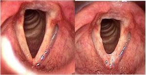 Laryngeal image before (left) and 3 months after glottoplasty (right) in inspiration, patient #5.