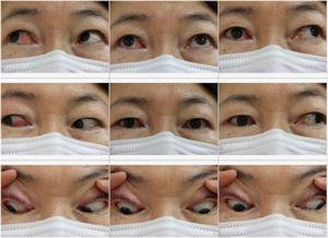 Image of the face and eye movements at 1 year after surgery. Right eye adduction improved, and no diplopia was seen during primary gaze. The scar from the modified Lynch incision was barely noticeable.