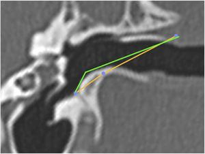 Angulation of the canal before and after drilling. The green line shows the angulation of the canal showing the trajectory tangent to the curvature of the floor. The orange line shows the angulation if the floor was drilled up to the limit of the infratemporal soft tissues. In this case, from a VAC of 51°, we would have an angle of 8°.
