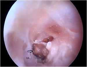 Lower edge of the tympanic membrane after drilling the lower portion of the canal. DA, Drilled area.
