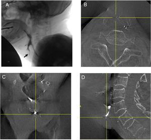 Videofluoroscopy and contrast CBCT findings of Case 4. A, Videofluoroscopy showed a suspicious minor pharyngeal leakage. The black arrow indicates the suspicious leakage. (B–D) The intersection of the vertical and horizontal yellow lines indicates the same location. CBCT detected no leakage.