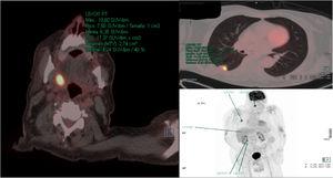 PET-CT showed an uptake of 18F-FDG in a nodule of the lower lobe of the right lung, and in the right palatine tonsil.