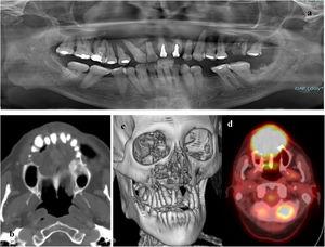 Wide maxillary osteolytic lesion associated with dental root resorption and involvement of the right maxillary sinus: orthopantomography (a), axial CT (b), 3D reconstruction (c) and PET (d) images.