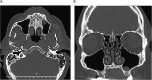 Computed tomography scan of the sinus. Axial view (A) and coronal view (B) of CT sinus scan suggest mild paranasal sinus inflammatory disease and a hyperdense structure within the left maxillary sinus that is likely a small mucous retention cyst or polyp.