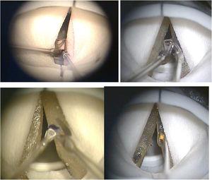 Microscopic image of surgical simulations in the larynx model. Source: the author.