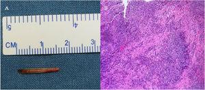The removed fishbone was approximately 16-mm in length (A); pathological findings included proliferation of fibrous collagen tissue, formation of inflammatory granulation tissue in areas, with more neutrophil accumulation in the focal area and calcium salt deposition (B).
