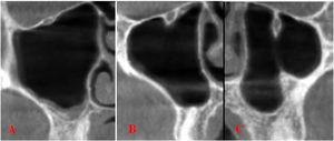 Coronal scans of Type 1 (A) and Type 2 (B) and Type 3 (C) based on the classification made by Ference et al.11