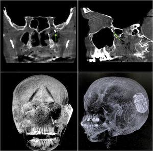 Control computed tomography obtained after neurostimulator implantation. (A and B) Bone window, coronal and sagittal sections respectively; green arrow represents the location of the electrode tip within the sphenopalatine ganglion. (C and D) Three-dimensional reconstruction, allowing visualization of the entire electrode path and location of the internal pulse generator.