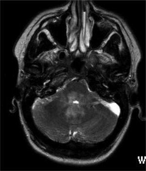 – Resonancia magnética del encéfalo que muestra la hiperintensidad característica en el rombencéfalo que rodea al cuarto ventrículo.
