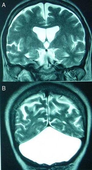 IRM coronales en T2. A. Los ventrículos laterales y el tercero tienen una moderada dilatación. Los surcos corticales no están agrandados y el parénquima no muestra lesiones. B. La fosa posterior sólo tiene LCR.