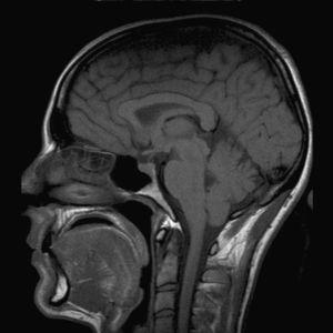 RMN de cráneo (sagital T1 sin contraste).