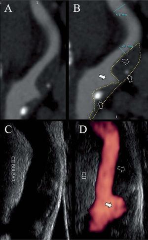 Ecodoppler con power-doppler y angiotomografía de arteria carótida interna. A y B: tomografía computarizada multicorte de la arteria carótida interna, que muestra una estenosis a nivel bulbar por una placa con componente fibrolipídico (flechas punteadas), escaso componente cálcico (flechas negras) y una gran úlcera (flechas blancas). C y D: la misma arteria evaluada por eco doppler (C) y power-doppler.