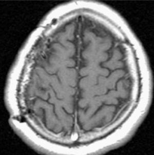 IRM con contraste, postoperatoria, sin evidencia de tumor.