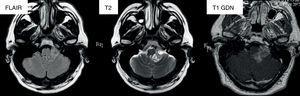 RM craneal. De izquierda a derecha, secuencia FLAIR, T2 y T1 con gadolinio. Apréciese cómo la masa ocupa el receso lateral del cuarto ventrículo y se dirige al ángulo pontocerebeloso a través del foramen de Luschka.