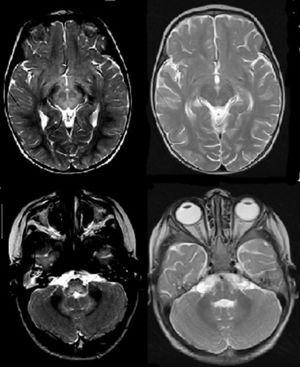 A la izquierda, sagital T2, médula cervical ensanchada e hiperintensa; imagen de la derecha, coronal T2, con tumefacción e hiperintensidad de señal del tronco encefálico.